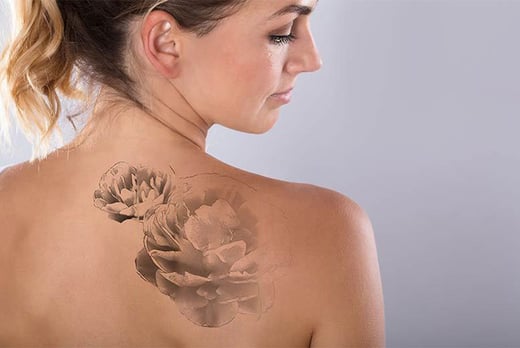 Laser Tattoo Removal Voucher - Bodmin