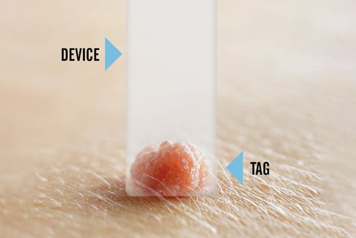 Tagcure-Skin-Tag-Removal-Device-7