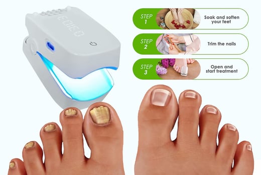 Fungal Nail Laser Device-1